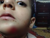 الكلاب الضالة تهاجم طفلا وتحدث به إصابات بالغة بمدينة السلام