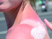 كيف تتعامل مع تقشير الجلد وحروق الشمس فى 5 خطوات؟
