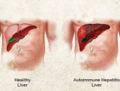 هل يمكن أن تصاب بالتهاب الكبد سي من نقطة دم أو جرح صغير؟