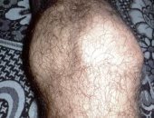 معاق ومش معاق بورق حكومى.. شاب يشكو من استخراج تقرير طبى مخالف لحالته