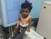 فيديو وصور.. مأساة الطفل "عمر" يتغذى ويتنفس من فتحتين بالجسم.. ويناشد بعلاجه
