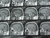 قارئ يناشد وزارة الصحة بعلاج "والده" على نفقة الدولة بعد إصابته  بورم فى الدماغ