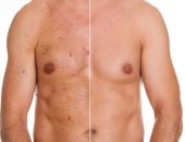 الليمون وخل التفاح للتخلص من حبوب الصدر فى فترة قصيرة