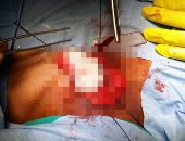 مستشفى سوهاج الجامعى يستخرج جسم زجاجى ممتد من الرقبة إلى الصدر