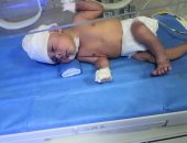 المستشفى الجامعى بسوهاج يستأصل ورما يزن 5 كيلو برأس مولود عمره 3 أيام