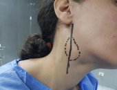 فريق طبى بالمستشفى التعليمى بطنطا ينجح فى استئصال ورم "الجسم السباتى"