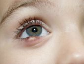 ما هي المدة المتوقعة لشفاء العين نتيجة التهاب القرنية