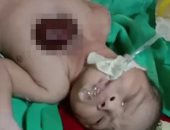 فيديو.. ولادة طفل بالهند بقلب خارج الصدر بسبب مرض نادر  