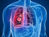 الأعراض متشابهة.. كيف تفرق بين التهاب الصدر وسرطان الرئة؟