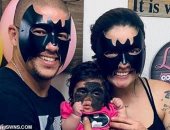 نجاح أول عملية فى روسيا لحالة نادرة من وحمات الوجه للطفلة "باتمان" ..صور