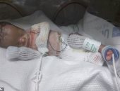 أطباء ينجحون فى إنقاذ طفل ولد دون جلد.. وأمه تحتضنه لأول مرة.. صور