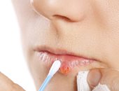 نصائح تساعد فى علاج قرح الفم منها الأدوية المضادة للفيروسات
