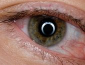 نصائح لعلاج التهاب ملتحمة العين.. ومتى تذهب للطبيب؟
