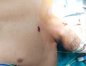 مستشفى سوهاج الجامعى تنقذ شابا من الموت بعد إصابته بطلق نارى