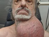 إزالة ورم سرطانى نادر بحجم كرة القدم من رقبة أمريكى.. صور 