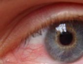 الضمور البصرى مرض خطير يعرضك للعمى.. كيف تحمى نفسك منه؟
