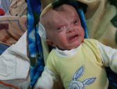 الطفلة زينب 6 شهور وتعانى من ضمور فى المخ وتحتاج جراحة عاجلة.. صور