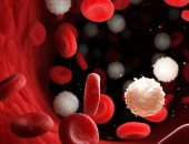 ما هو سرطان الدم؟ تعرف على الأعراض وخيارات علاج اللوكيميا