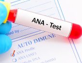 تحليل الأجسام المضادة للنواة ANA وأهميته في اكتشاف الأمراض  