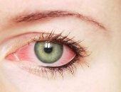 العين البيضاء.. التهاب خطير يصيب العيون.. ماهى أعراضه؟