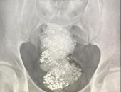 القبض على أفريقى أخفى 297 جرام ألماس فى أحشائه محاولا تهريبها إلى الإمارات