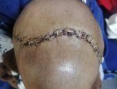 مستشفى سوهاج الجامعى تجرى جراحة بمخ طفل لحمايته من فقدان البصر