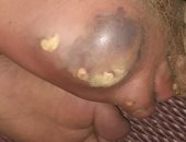 "سيبها علينا".. قارىء يستغيث بالصحة لنقل شقيقه إلى مستشفى متخصصة بالأورام 