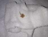 استخراج شوكة سمكة من القصبة الهوائية لطفلة عمرها عام ونصف بـ"بنها الجامعي"