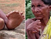 مسنة هندية تدخل موسوعة جينيس بـ31 إصبعا فى يديها وقدميها.. صور