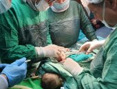 وكيل صحة المنوفية ينقذ حياة طفلة عمرها 27 يوما بإجراء جراحة عاجلة