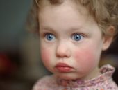 صفع الخد.. مرض يصيب الأطفال يسبب احمرار الخدود