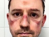 صور.. تعب وإرهاق الأطباء فى إيطاليا بسبب تزايد عدد مصابى فيروس كورونا