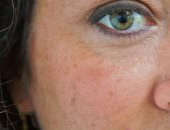 هل لديك بقع الشيخوخة على بشرتك؟ وصفات بسيطة تخلصك منها