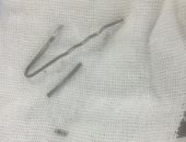 مستشفى سوهاج الجامعى ينقذ رضيعة بعد استخراج "بنسة" من جهازها التنفسى