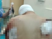 استخراج سيخ حديد اخترق الرئة اليسرى لمواطن بمستشفى الطوارئ بجامعة المنصورة