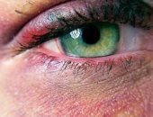 تعرف على طرق علاج كدمات العين أبرزها الكمادات والتدليك
