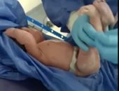 فيديو.. أول عملية ولادة قيصرية لأم مصابة بفيروس كورونا
