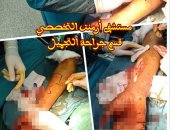 أطباء مستشفى أرمنت التخصصى ينجحون فى إنقاذ مواطن من بتر إصبعه 