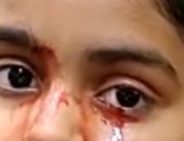 فتاه هندية تبكى بدل الدموع "دم" فى حالة طبية نادرة