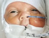 ديلى ميل: ولادة طفل بحجم "الريموت" فى حالة نادرة بعد خضوعه لجراحتين