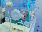 إجراء جراحة عاجلة بالمخ لطفلة عمرها 11يوما بمستشفى فاقوس النموذجى