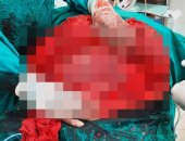 استئصال جزء منحشر داخل أمعاء سيدة يزن 12 كيلو فى مستشفى بطنطا