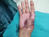 صور.. جراحة تجميلية لإنقاذ يد مريض يعانى من كسر متفتت بإصبع الإبهام الأيمن بأرمنت