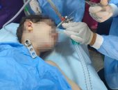 فريق جراحى بمستشفى بنها الجامعى ينجح باستخراج سوكت شاحن من القصبة الهوائية لطفل