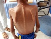 يونيسيف تحذر من سوء التغذية باليمن: مليونى طفل فى صراع بين الحياة والموت