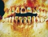 دراسة الحمض النووى للأسنان تكشف: الإنسان عانى من الطاعون قبل 5 آلاف سنة