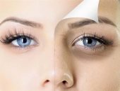 الشيخوخة وعوامل الوراثة.. أسباب مختلفة لظهور الأوردة البارزة تحت العينين