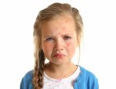 هل يصاب الأطفال بـ"حب الشباب" وما هي أعراضه؟