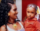 إثيوبية تخضع لعملية إعادة بناء الوجه بعد تعرضها لمادة حارقة.. صور