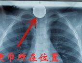 إنقاذ طفلة صينية بجراحة عقب ابتلاعها عملة معدنية.. صور